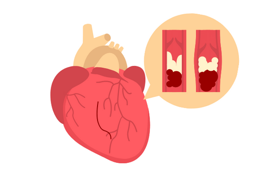 Healthcare Illustration template: Heart Disease Illustration (Created by InfoART's  marker)